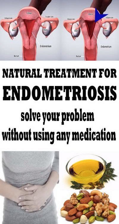Natural Treatment For Endometriosis Endometriosis Naturalremedies Endometriosis Treatment