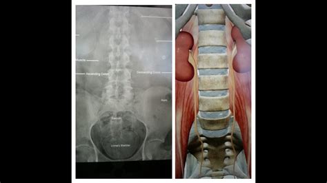 X Ray Kub Basics Kidney Ureter Bladder Youtube