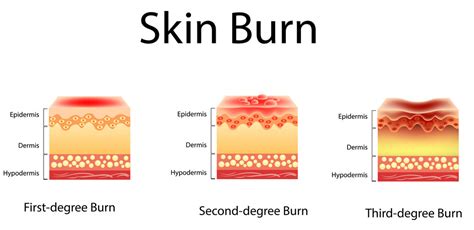 Classification Of Burns Public Health Notes