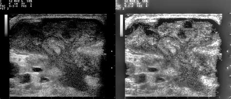 Nevits Blog Ultrasound Image Of Breast Abscess Original Version And