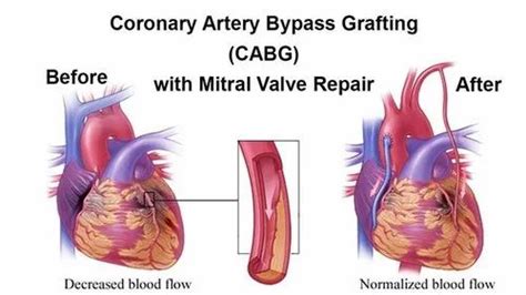 Cabg Surgery Coronary Artery Bypass Surgery In India
