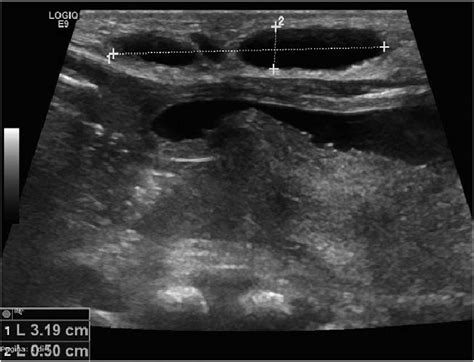 Abdominal Ultrasound Scan Showing Subcutaneous Cysts 1 Maximum