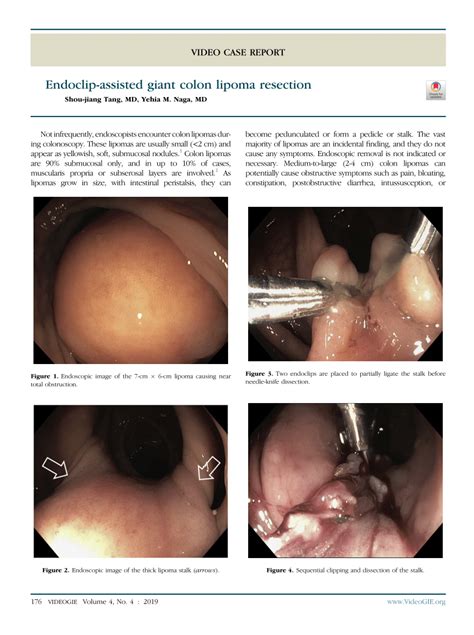 Pdf Endoscopic Resection Of A Giant Colonic Lipoma With Endoloop My