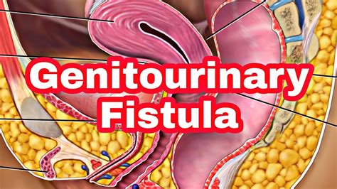Genitourinary Fistulacausessymptoms Diagnosistreatment Youtube