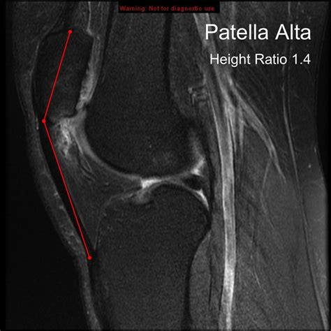 Patella Alta With Hoffa S Fat Pad Impingement Image Radiopaedia Org