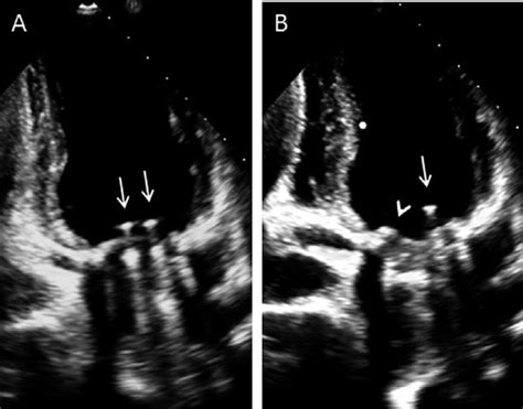 Two Dimensional Transthoracic Echocardiogram Of The Mechanical Mitral