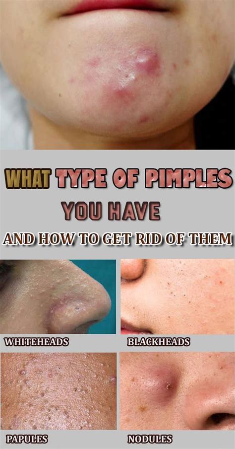 What Type Of Pimples You Have And How To Get Rid Of Them