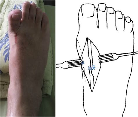Incision Site At Dorsal Side Of Right Foot And Old Operative Scar At
