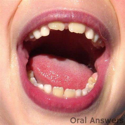 Calcification On Toddler Teeth Teeth Bonding