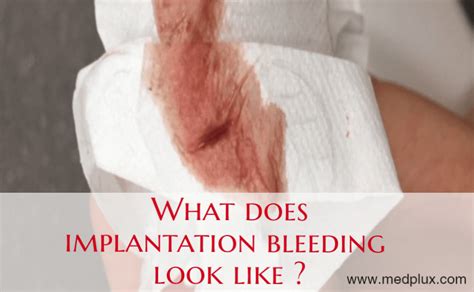 What Does Implantation Bleeding Look Like Early Pregnancy Pictures