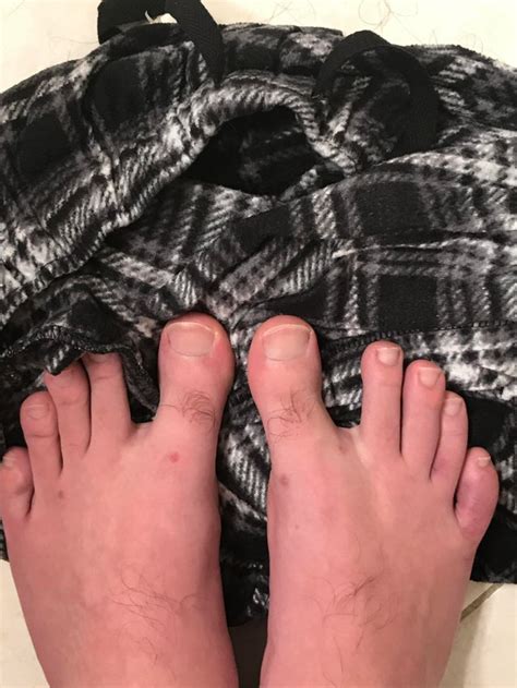 Actually, they are less common than you think. red spots on feet, some red spots on heel, purple toe, no symptoms of covid-19, i have no clue ...