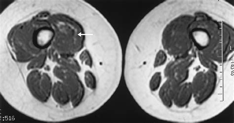 Soft Tissue Cavernous Hemangioma Radiographics