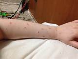 Treatment To Get Rid Of Bed Bugs Photos