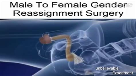 Male To Female Gender Reassignment Surgery YouTube