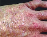 Lichenoid Eruption in a Patient With AIDS—Quiz Case | JAMA Dermatology ...