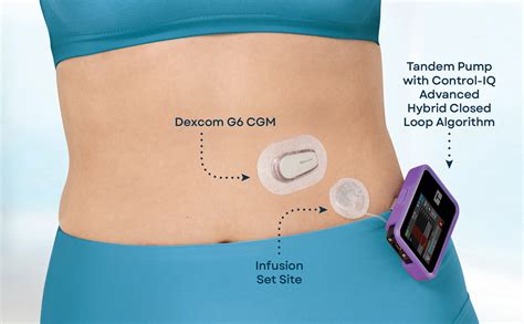 What is an Automated Insulin Delivery System?