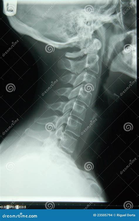 Human Neck X Ray Stock Images Image 23505794