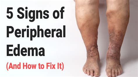 5 Signs Of Peripheral Edema And How To Fix It Power Of Positivity