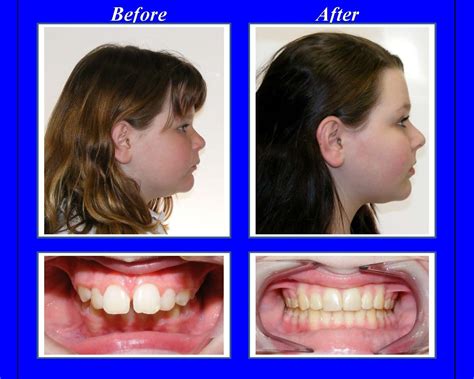 Maybe you would like to learn more about one of these? This patient's overbite was more than 4 times the normal ...