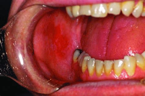 The Erythematous Or Atrophic Variant Of Olp On The Right Buccal Mucosa