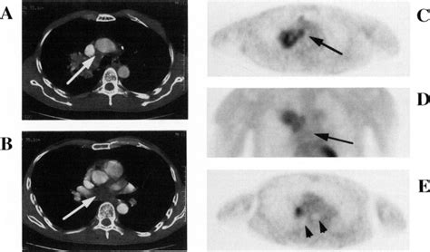 Mediastinal Lymph Node Staging With Fdg Pet Scan In Patients With
