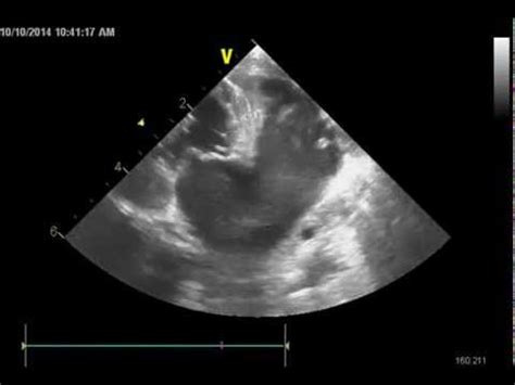 Portions of these intracavitary thrombi can break off and form emboli that infarct arterial branches, most commonly the aortic trifurcation (saddle emboli). Spontaneous echocontrast and evidence of an atrial ...
