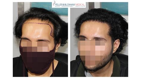 What Is Traction Alopecia Hair Transplant Repair Result Feller And Bloxham Medical Ny Nyc