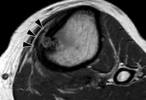 Radiologic Diagnosis Of Osteoid Osteoma From Simple To Challenging
