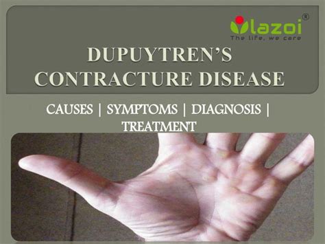 Dupuytrens Contracture Disease Causes Symptoms And Treatment Ppt