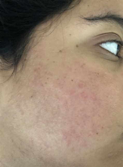 Skin Concern Redness Doesnt Go Away On Azelaic Acid 4 For More