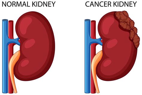 Types Of Treatments For Kidney Cancer Urologist