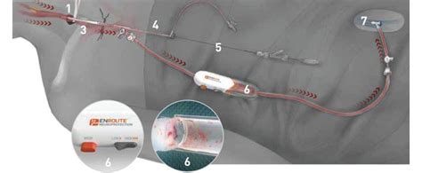 Major Breakthrough In Treatment Of Carotid Artery Disease Vascular