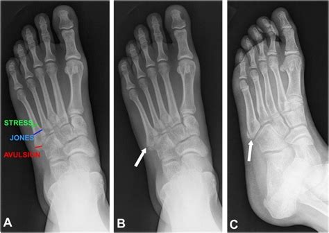 Fractures Of The Fifth Metatarsal Base Frontal Radiograph A Download Scientific Diagram