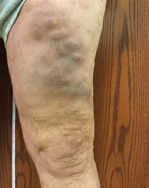 What Is Thrombophlebitis Vein Specialists Of The Carolinas