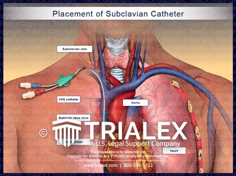 Placement Of Subclavian Catheter Trialexhibits Inc