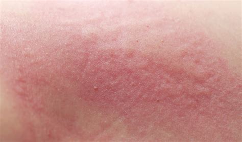 What Causes The Lupus Butterfly Rash Redorbit