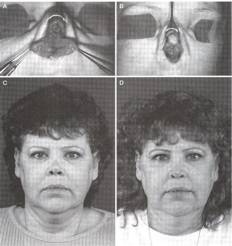 Long Term Follow Up Of Repair Of External Nasal Deformities In Patients