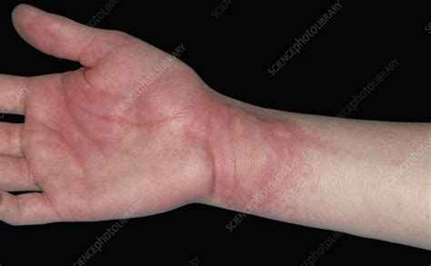 Hives Stock Image C0531911 Science Photo Library