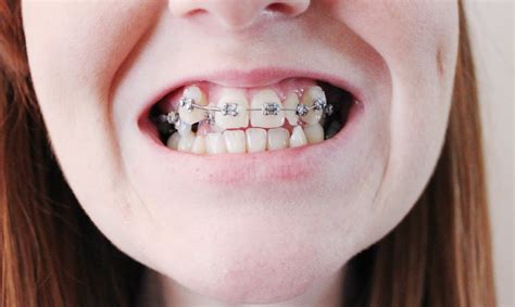 The brace lady: My first month in braces
