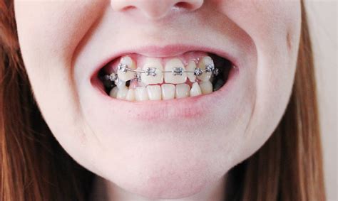 Know what to eat with braces the first week and stock up. The brace lady: My first month in braces