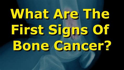 What Are The First Signs Of Bone Cancer Youtube