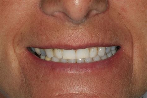 Veneers In Southampton Cosmetic Dentist Barker Dental Care