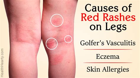 Red Rash On Legs