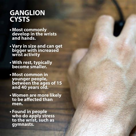 what is a ganglion cyst symptoms causes and treatments hot sex picture