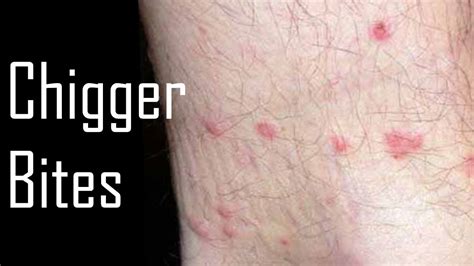 Chigger Bites Vs Bed Bug Bites