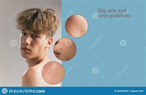 Oily Skin And Male Problem Acne Blackhead Pustule Papule Enlarged
