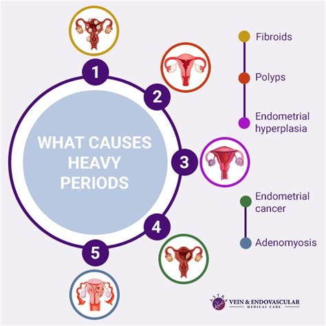 Heavy Periods Vein And Endovascular Medical Care