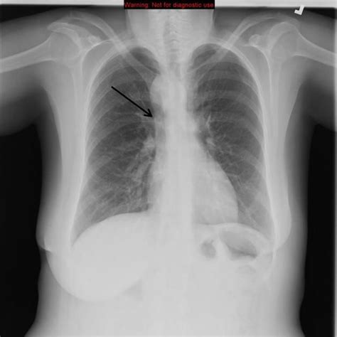 Right Sided Aortic Arch Arrow Is A Rare Variant Affecting 01 Of