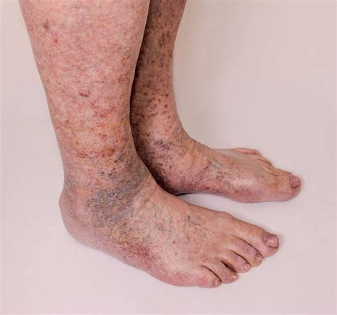 Varicose Leg Veins In Men Treatment In Pittsburgh Vein Center
