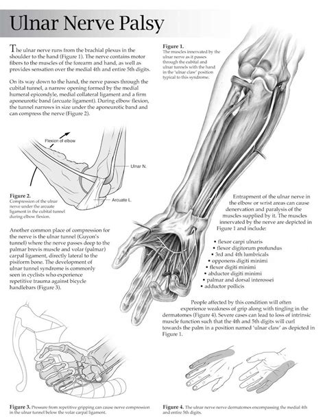 Other childhood elbow trauma has also been associated with tardy ulnar nerve palsy, including supracondylar fractures resulting in cubitus varus, fractures of the. Matan Berson | Interactive design & visualization for ...